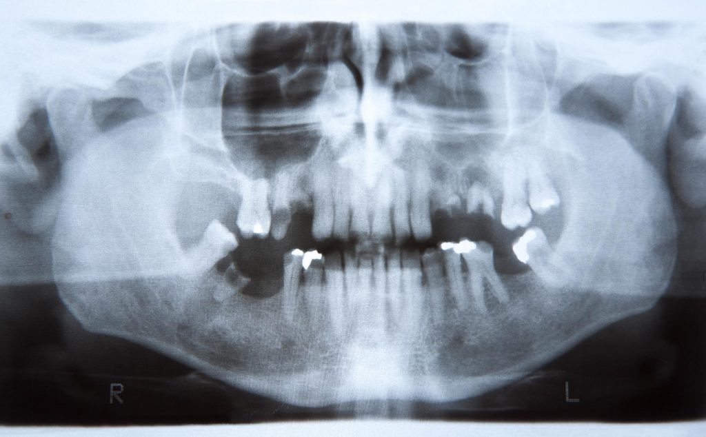 Extraction dents de sagesse au clinique dentaire la citière à la Prairie.